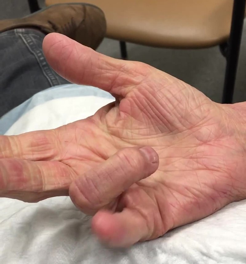 trigger finger treatment without surgery