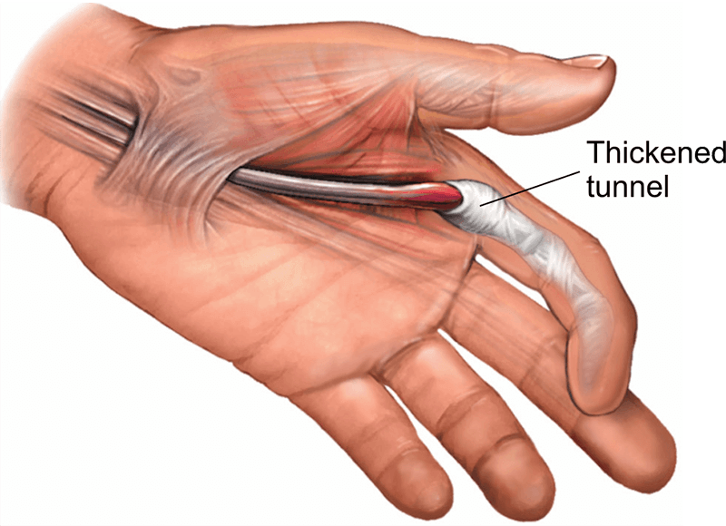 trigger finger treatment without surgery