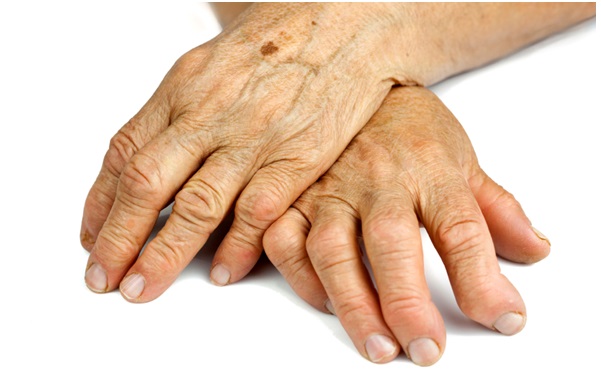 Rheumatoid arthritis