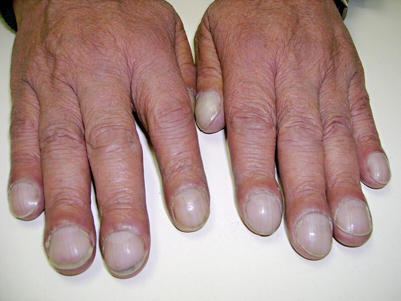 How to Detect the Presence of Nail Clubbing & Is Nail Clubbing Reversible  or Irreversible?