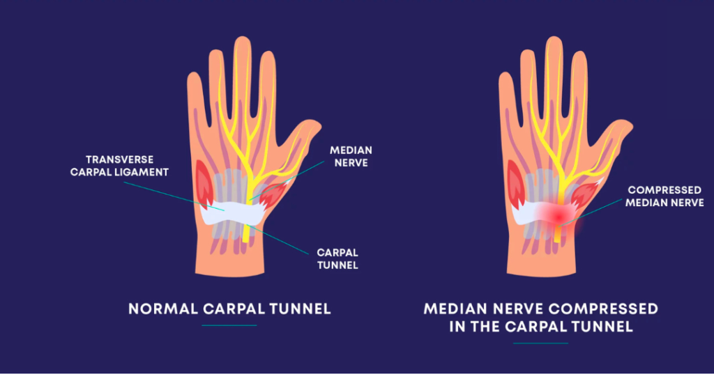 Carpal Tunnel Syndrome: Symptoms, Treatment, and Surgery Options in UAE